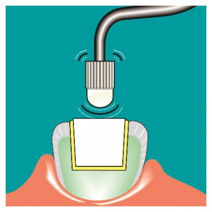 Insert SONICflex cem n°12
