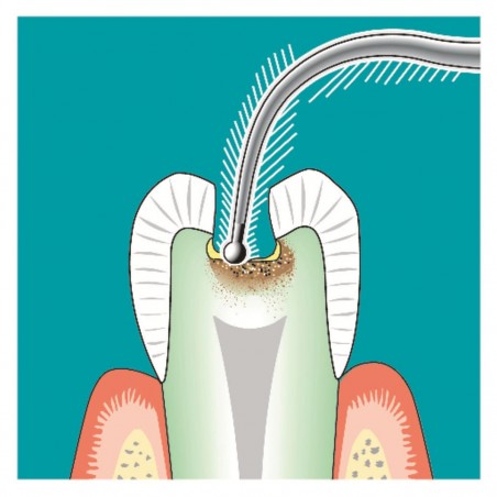 Insert SONICflex cariex 1.4 mm n°72