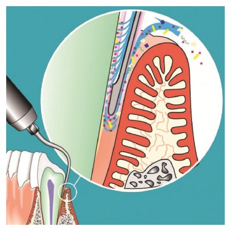 Insert SONICflex paro n°61A