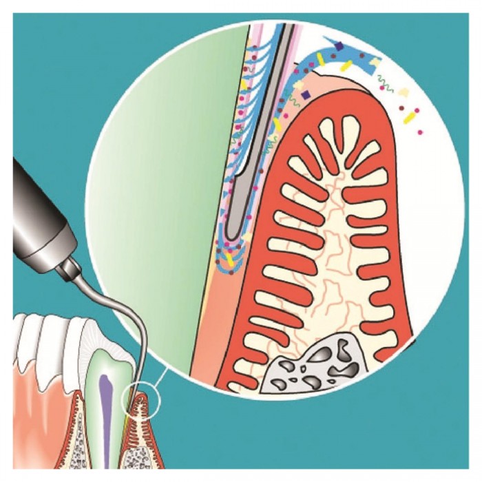 Insert SONICflex paro n°62A